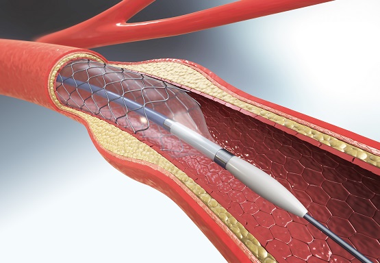 Diagnosing Heart Disease-Mount Alvernia Hospital